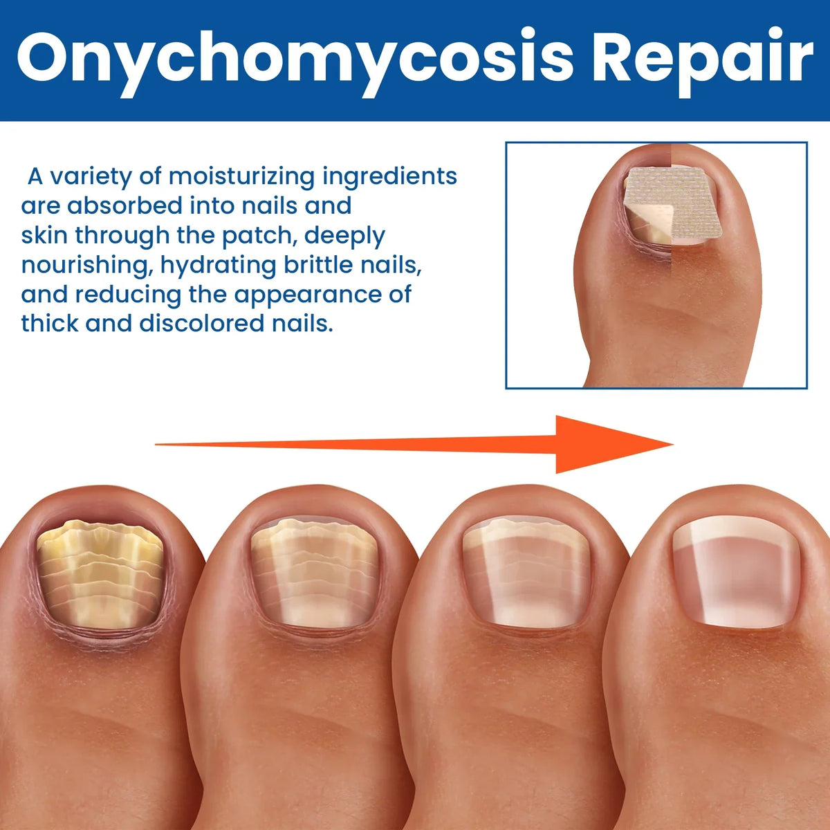 🔥🔥Turonu® Fungus Nail Repair Patches
