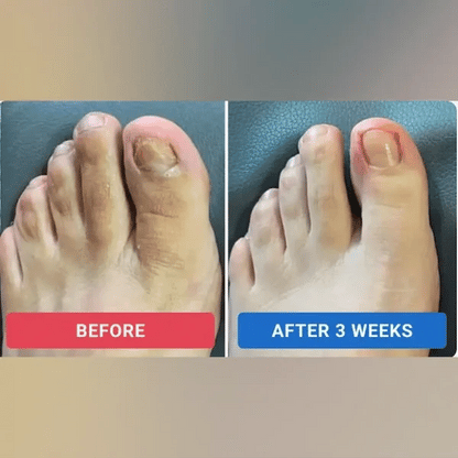 🔥🔥Turonu® Fungus Nail Repair Patches