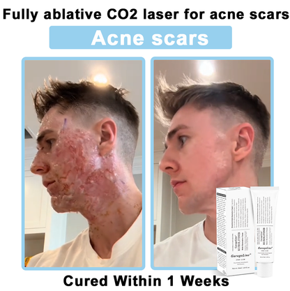 【GarageLine® Official Store】JAK-Smart Ruxolitinib Repair Complex 🏥（Zero Inflammation, 72H Sustained Release | Acne Clear in 10 Days | 97.7% Redness Reduction | Clinically Tested）