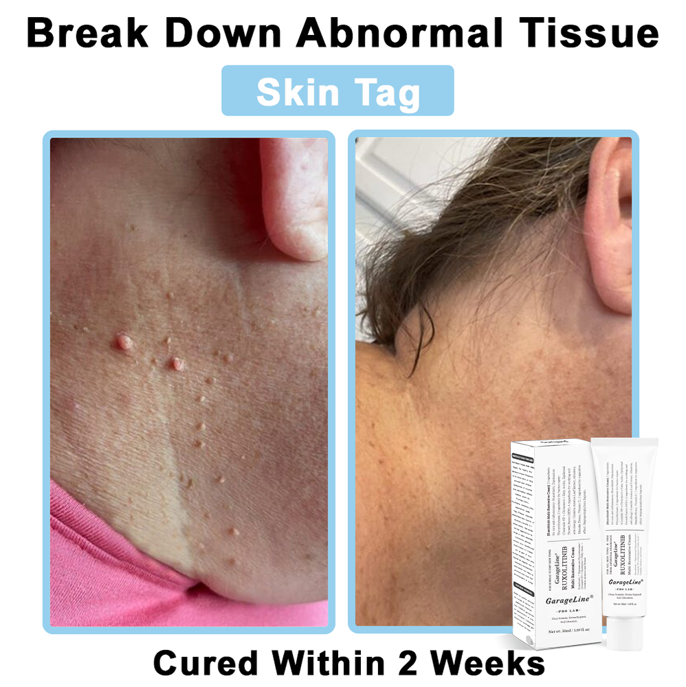 【GarageLine® Official Store】JAK-Smart Ruxolitinib Repair Complex 🏥（Zero Inflammation, 72H Sustained Release | Acne Clear in 10 Days | 97.7% Redness Reduction | Clinically Tested）