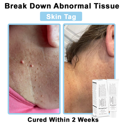 【GarageLine® Official Store】JAK-Smart Ruxolitinib Repair Complex 🏥（Zero Inflammation, 72H Sustained Release | Acne Clear in 10 Days | 97.7% Redness Reduction | Clinically Tested）