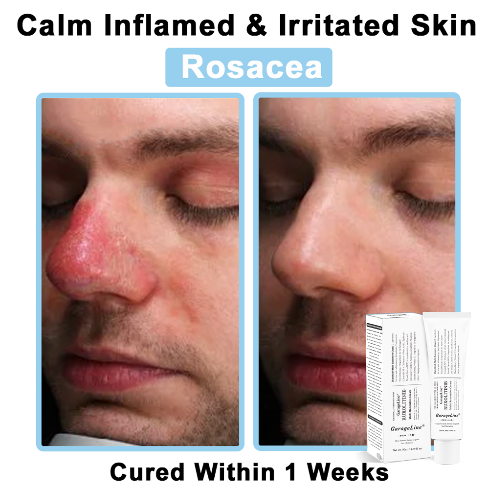 【GarageLine® Official Store】JAK-Smart Ruxolitinib Repair Complex 🏥（Zero Inflammation, 72H Sustained Release | Acne Clear in 10 Days | 97.7% Redness Reduction | Clinically Tested）