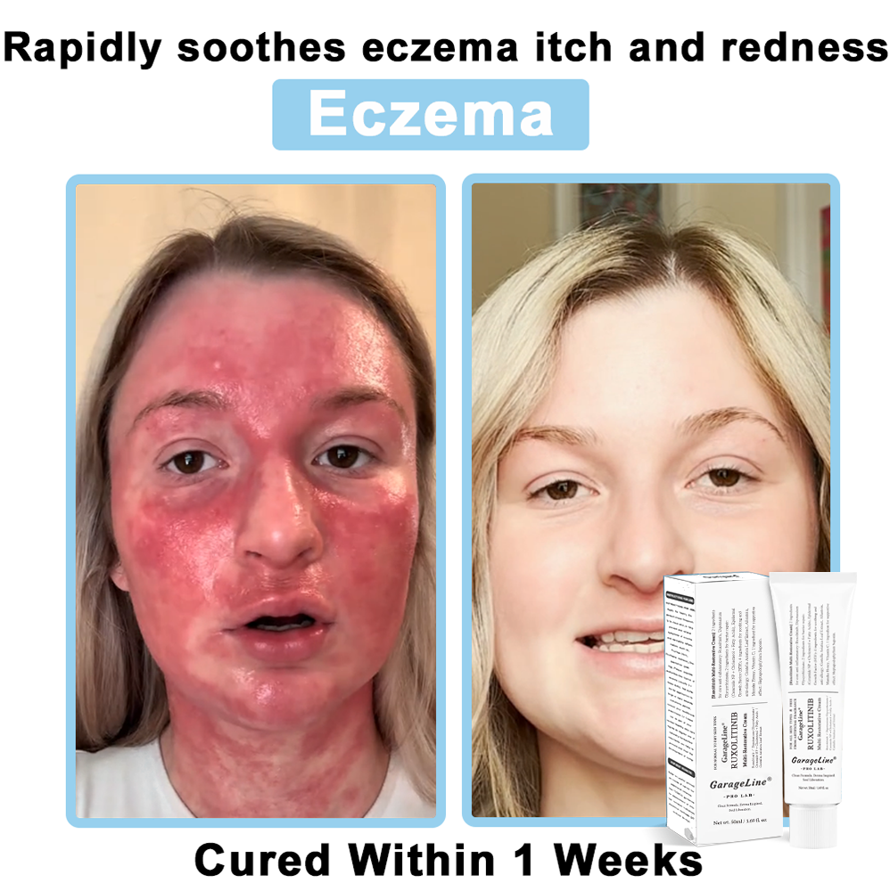 【GarageLine® Official Store】JAK-Smart Ruxolitinib Repair Complex 🏥（Zero Inflammation, 72H Sustained Release | Acne Clear in 10 Days | 97.7% Redness Reduction | Clinically Tested）