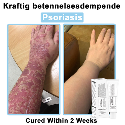 【GarageLine® Official Store】JAK-Smart Ruxolitinib Repair Complex 🏥（Zero Inflammation, 72H Sustained Release | Acne Clear in 10 Days | 97.7% Redness Reduction | Clinically Tested）