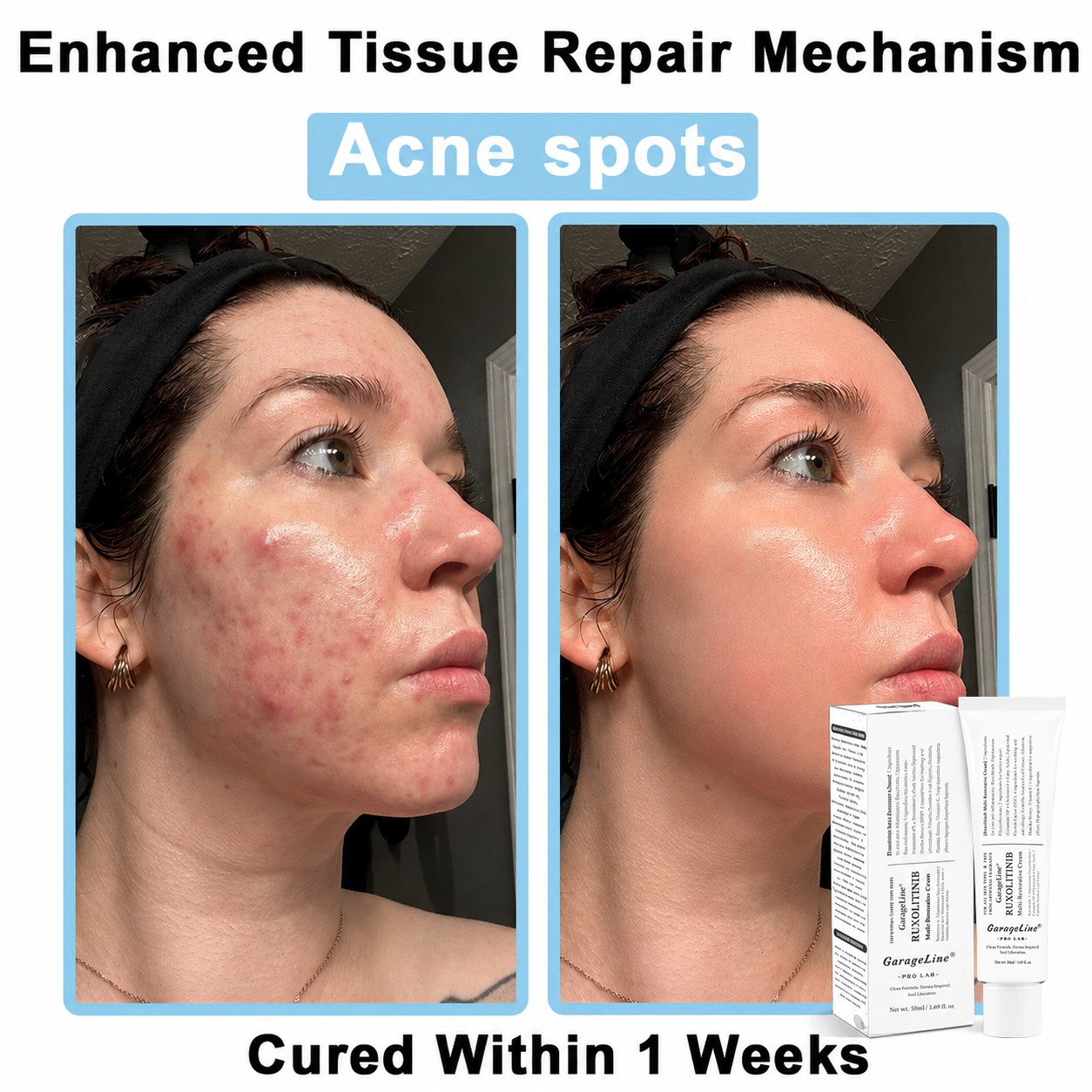 【GarageLine® Official Store】JAK-Smart Ruxolitinib Repair Complex 🏥（Zero Inflammation, 72H Sustained Release | Acne Clear in 10 Days | 97.7% Redness Reduction | Clinically Tested）