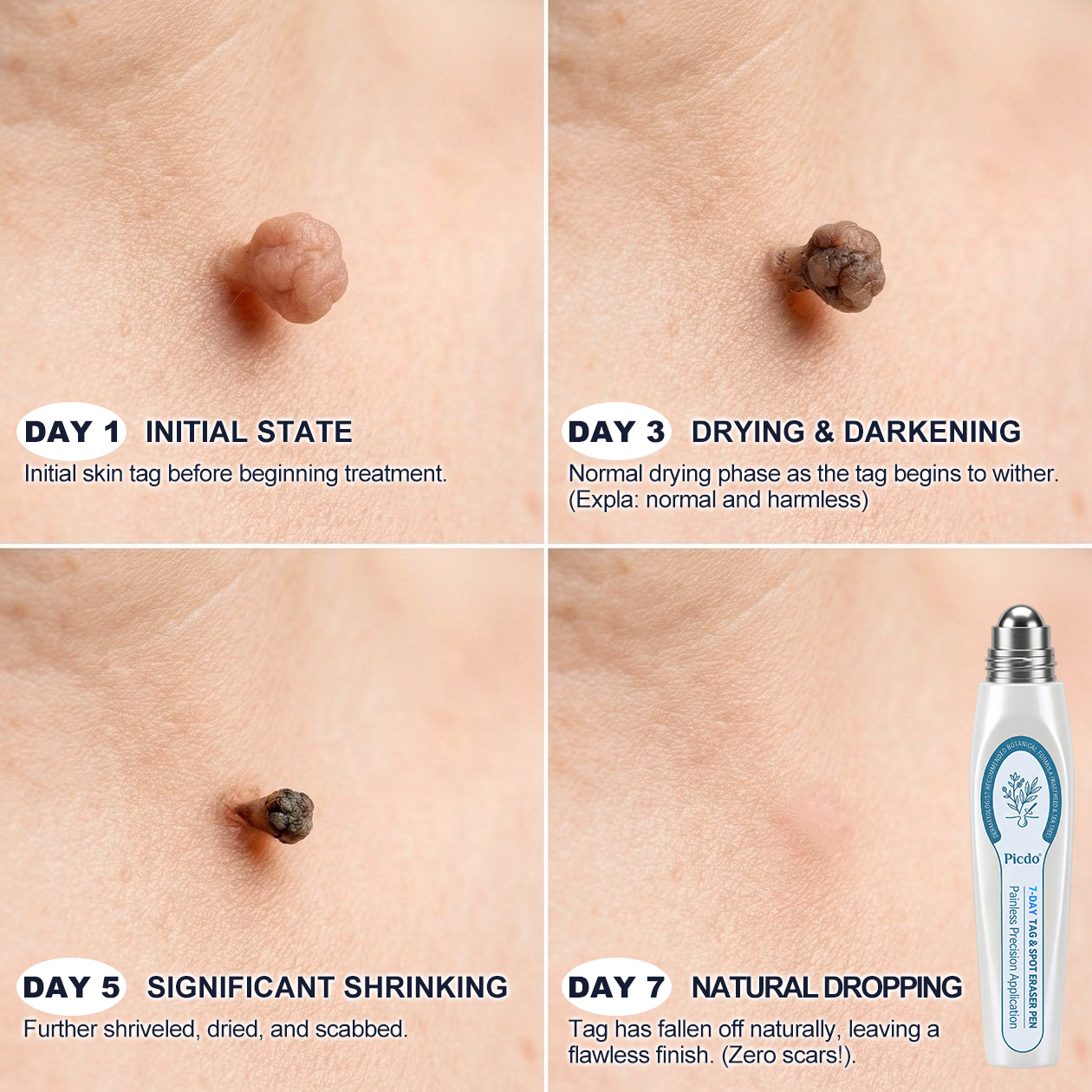 𝐇𝐞𝐚𝐥𝐫𝐢𝐳𝐞® 7-𝐷𝑎𝑦 𝗧𝐚𝐠 & 𝗦𝗽𝐨𝐭 𝐄𝐫𝒂𝒔𝒆𝒓(Zero Pain, Zero 𝐒𝐜𝐚𝒓𝒔 Rollerball)💪