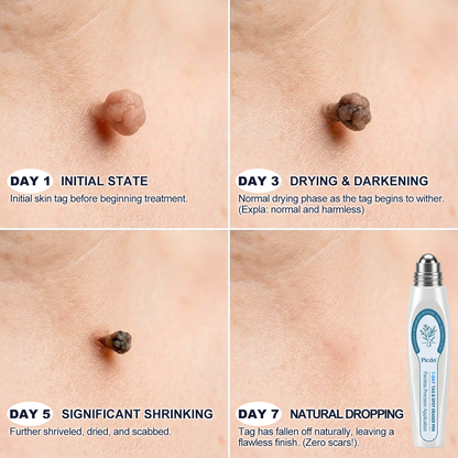 𝐇𝐞𝐚𝐥𝐫𝐢𝐳𝐞® 7-𝐷𝑎𝑦 𝗧𝐚𝐠 & 𝗦𝗽𝐨𝐭 𝐄𝐫𝒂𝒔𝒆𝒓(Zero Pain, Zero 𝐒𝐜𝐚𝒓𝒔 Rollerball)💪