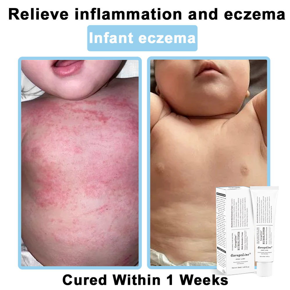 【GarageLine® Official Store】JAK-Smart Ruxolitinib Repair Complex 🏥（Zero Inflammation, 72H Sustained Release | Acne Clear in 10 Days | 97.7% Redness Reduction | Clinically Tested）