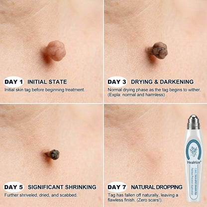 👩‍⚕️𝐇𝐞𝐚𝐥𝐫𝐢𝐳𝐞® ✨7-𝐷𝑎𝑦 𝗧𝐚𝐠 & 𝗦𝗽𝐨𝐭 𝐄𝐫𝒂𝒔𝒆𝒓(Zero Pain, Zero 𝐒𝐜𝐚𝒓𝒔 Rollerball)💪